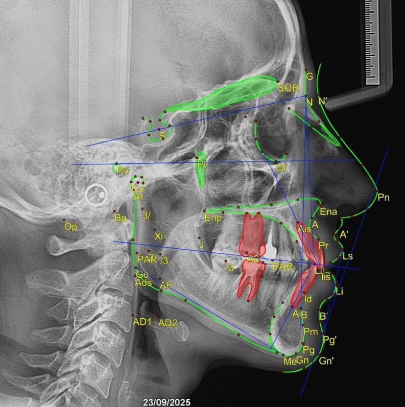 Radiografía cefálica lateral con trazado cefalométrico digital: puntos, planos y perfil de tejido blando marcados sobre el estudio